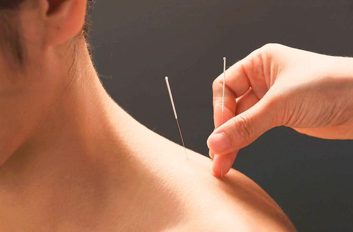 acupuncture for neck pain