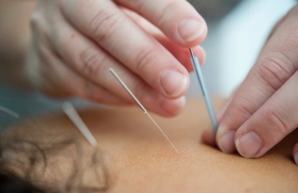 acupuncture for neck pain