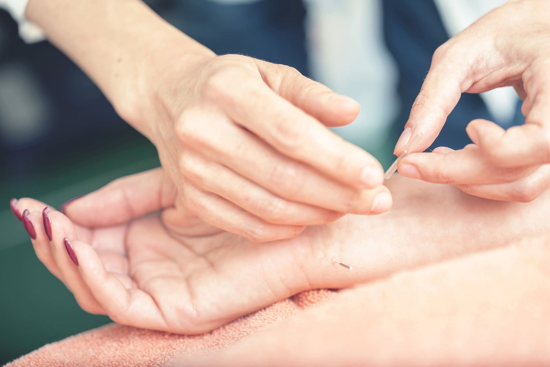  Acupuncture for Wrists