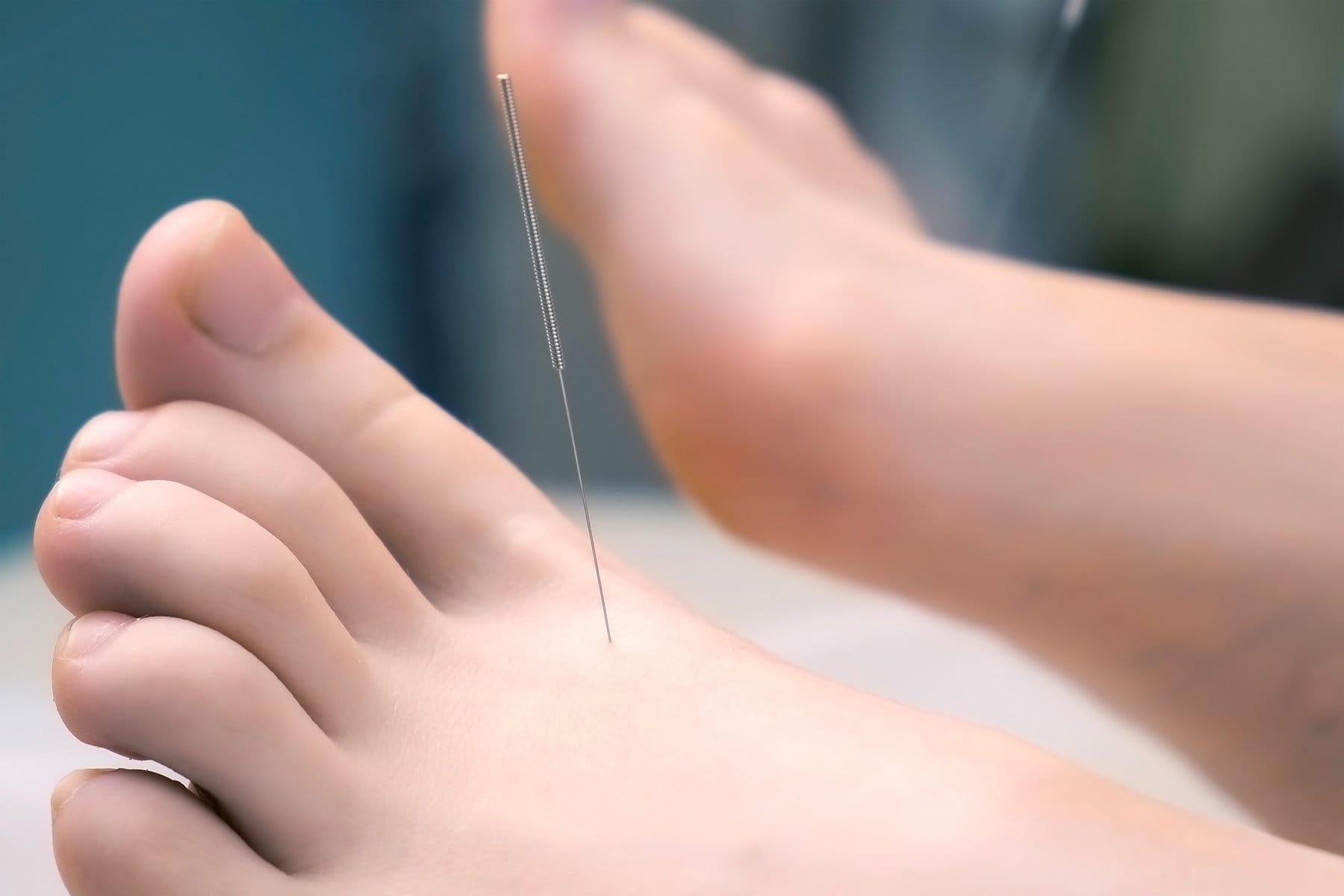  Acupuncture for Leg and Foot Cramps