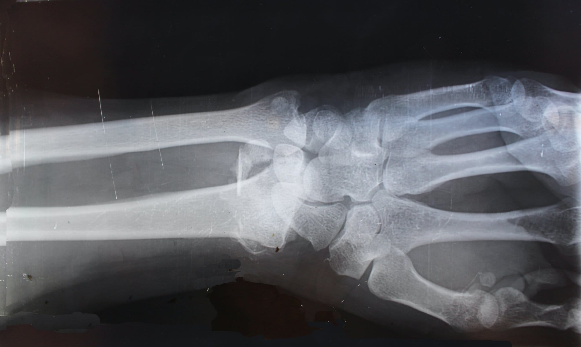 wrist X-ray investigating osteoarthritis