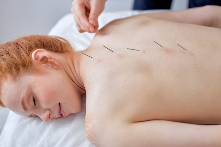 acupuncture for back pain, how does acupuncture work