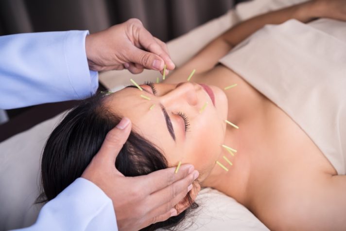 acupuncture for headaches